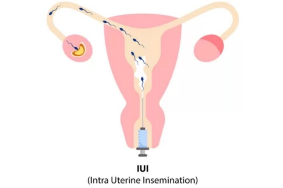 Fertility Treatment