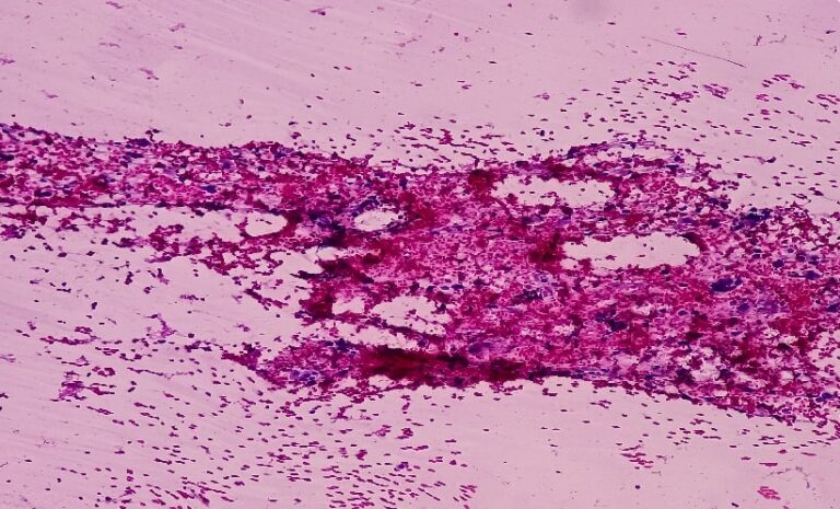 Bile Duct Cancer: PNI Linked to Survival Outcomes - EMJ
