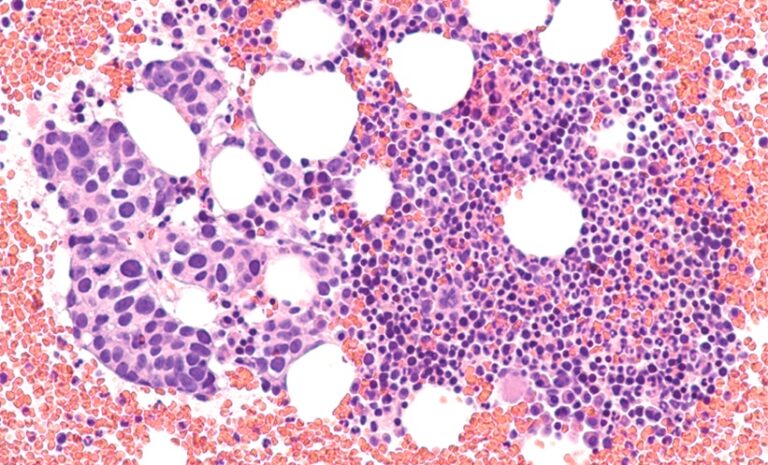 Breast Cancer MRI Shows High Subtype Accuracy