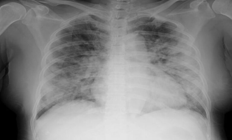 COVID-19 Chest X-Ray Abnormalities in Children