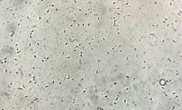 Seminal Plasma Biomarkers Predict Sperm Retrieval